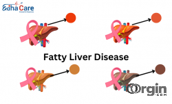 Fatty Liver Disease: Understanding the Silent Intruder